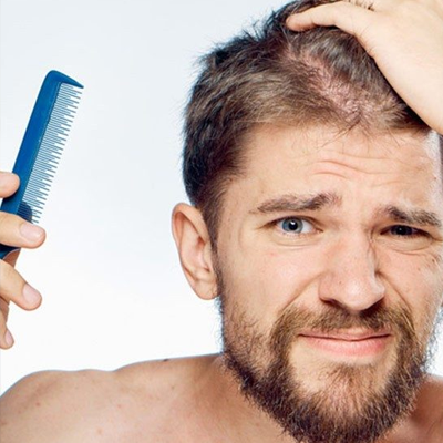 Queda de cabelo masculino
